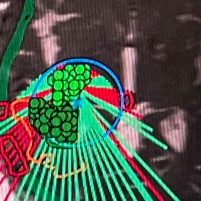 Glioblastoma