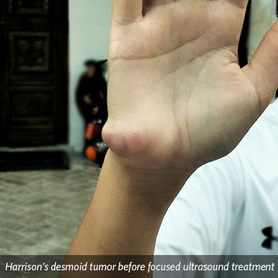 Harrison hand before treatment
